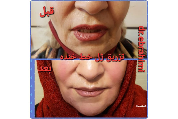 فیلر خط خنده در تهرانپارس