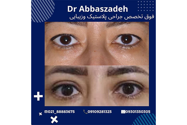 جراحی پلک بالا و پایین چیست؟