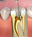  روتاری روشی مؤثر برای درمان عفونت ریشه دندان در دندانپزشکی رویا