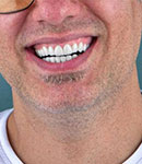 زیباسازی و اصلاح خط لبخند در دندانپزشکی مهر پارسه