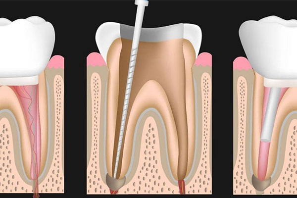 درمان عفونت ریشه دندان در شهرک غرب