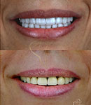درمان‌های زیبایی لمینت سرامیکی در  دندانپزشکی دکتر آناهیت افراسیابی