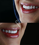 کامپوزیت ونیر؛ روشی ارزان برای خلق لبخندی زیبا در دندانپزشکی دکتر آناهیت افراسیابی