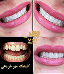 طراحی لبخند با استفاده از کامپوزیت ونیر و لمینیت سرامیکی در دندانپزشکی مهر شریعتی