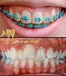 همه چیز درباره روش درمانی ارتودنسی دیون برای ترمیم اختلالات دندانی