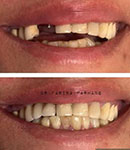 پروتز ثابت و متحرک دندان توسط دکتر فریبا فرهنگ،همه چیز درباره انواع، مزایا و معایب