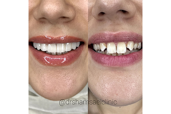 کامپوزیت دندان تخصصی در سعادت آباد