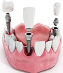 ایمپلنت دندان چیست و فواید انجام دادن آن توسط دکتر نریمان قره داغی چیست؟