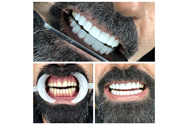 بهترین مرکز کامپوزیت دندان در سعادت آباد