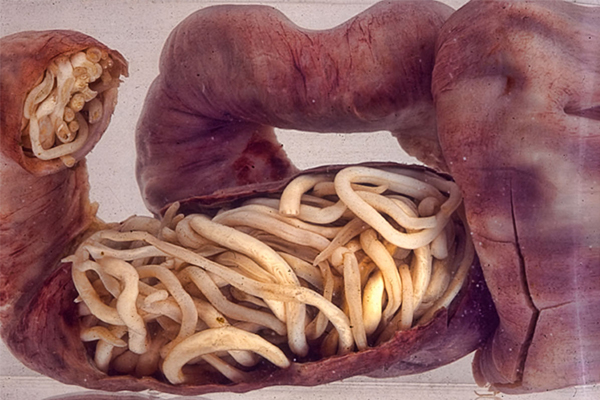 عوارض ناشی از آسکاریازیس