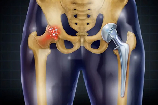 دلایل مشکلات مفصل لگن در سالمندان