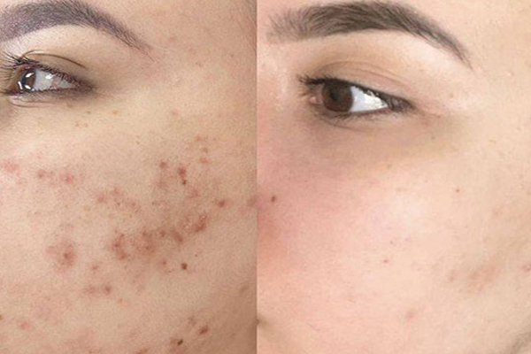 مراقبتهای پس از درمان اسکارهای آکنه