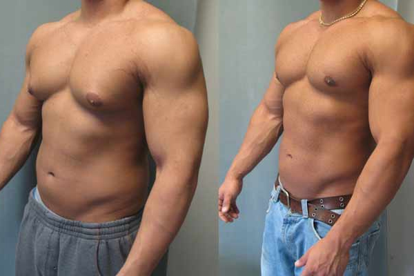 بهترین رژیم غذایی ژنیکوماستی