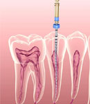 فرق درمان ریشه با عصب کشی دندان توسط دکتر آتنا ربیعی چیست؟