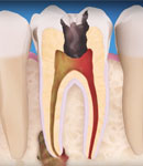 درمان ریشه دندان توسط دکتر نازنین نوربخش 