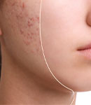 چه افرادی کاندیدای مناسب سابسیژن پوست هستند؟