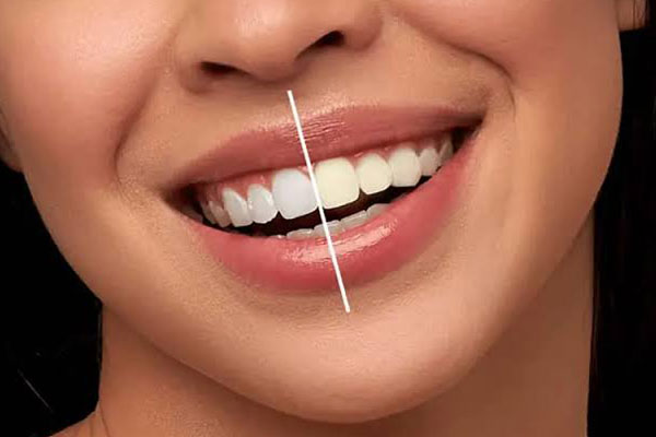 چه کسانی باید بلیچینگ دندان انجام دهند؟
