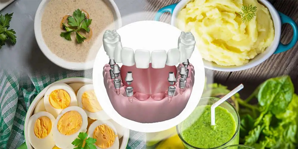 بعد از ایمپلنت دندان چه چیزهایی می‌توان خورد؟