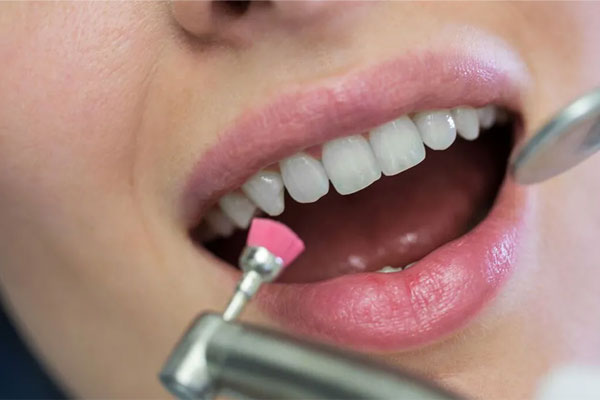 مزایای اصلی بروساژ دندان