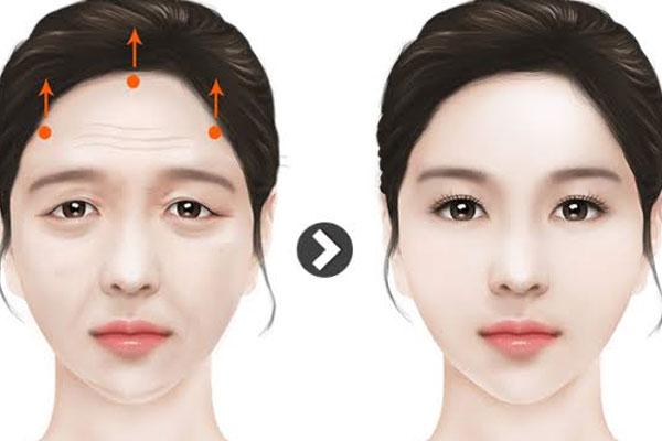 لیفت شقیقه برای چه افرادی مناسب است؟