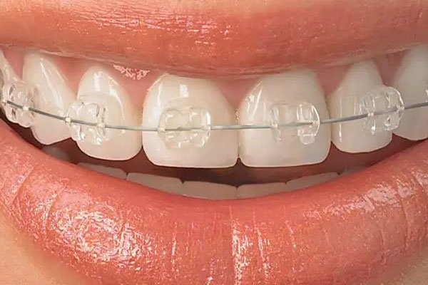 چرا به بزرگسالان ارتودنسی نامرئی پیشنهاد می‌شود؟ عدم نمایان بودن