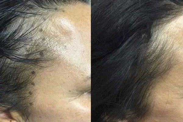 نکات مهم در تزریق هیر فیلر برای رویش مو