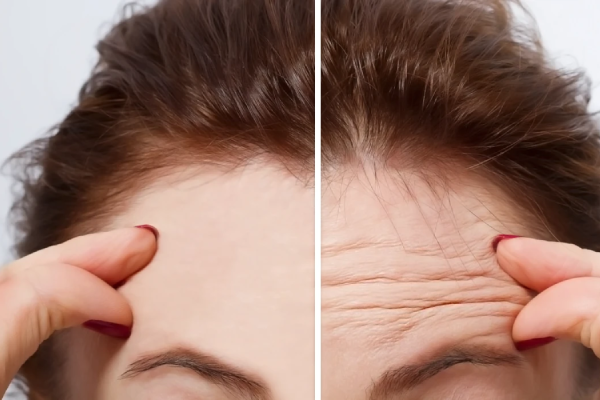 زمان مشاهده اثر بوتاکس به چه صورت است؟