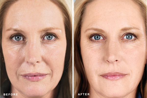 تزریق کلاژن چیست؟