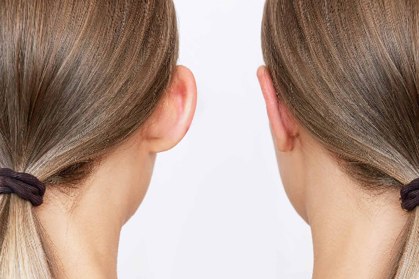 سن مناسب برای انجام اتوپلاستی