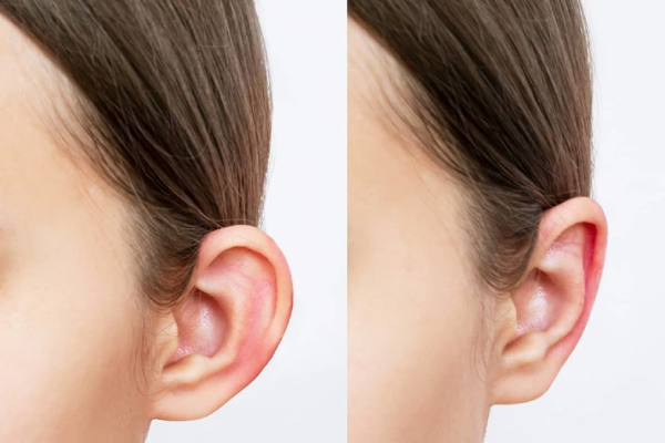 کاندید های مناسب برای انجام جراحی اتوپلاستی