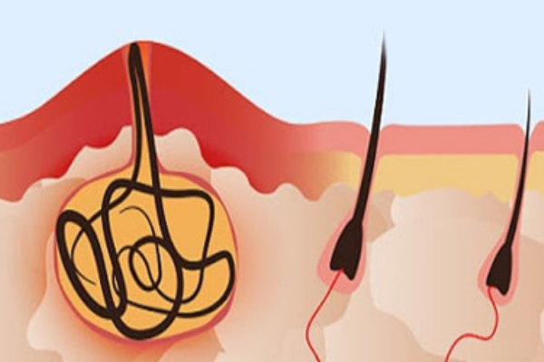 مراقبت های بعد از جراحی کیست مویی