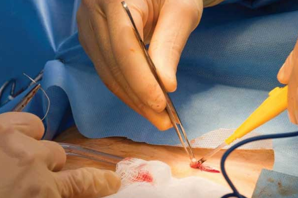 مراحل جراحی کیست مویی