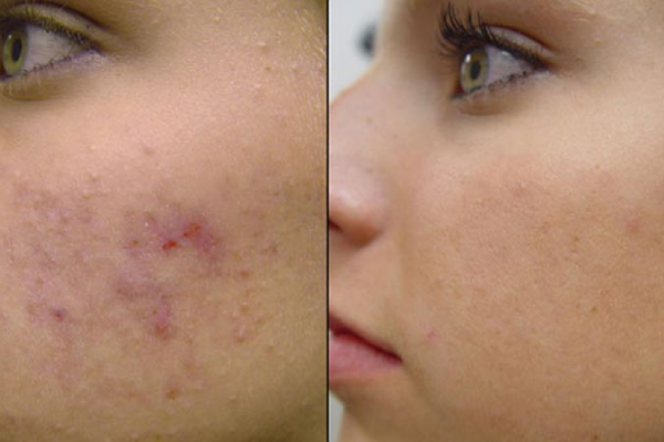 میکرونیدلینگ مناسب چه افرادیست؟