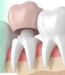 مراقبت‌های بعد از روکش دندان،آنچه باید بدانید