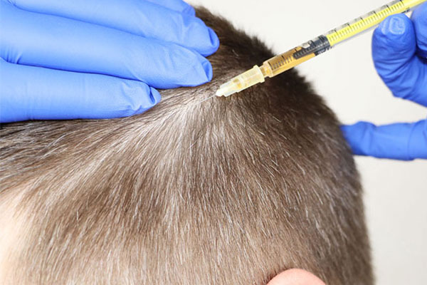 مراحل انجام پی آر پی مو مردان