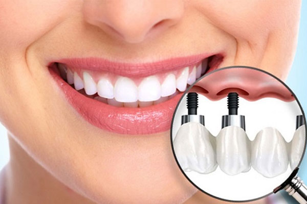 ایمپلنت دندان جلو چیست؟