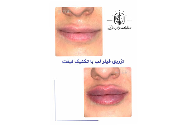 چرا فیلر لب طبیعی انتخاب هوشمندانه‌تری است؟