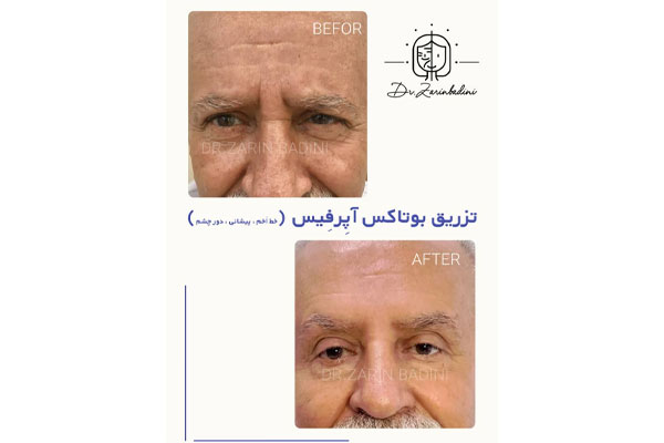 بوتاکس چیست و چگونه باعث کاهش چین‌وچروک می‌شود؟