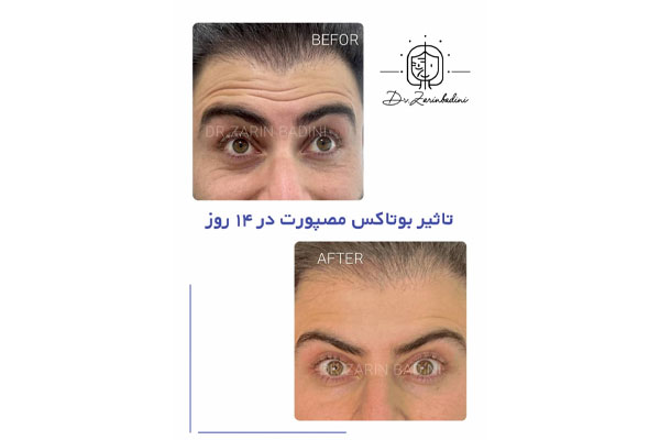 بهترین سن برای شروع تزریق بوتاکس چه زمانی است؟