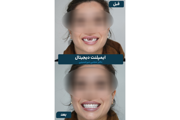 هنگام انتخاب کلینیک ایمپلنت دندان اقساطی به چه نکاتی توجه کنیم؟