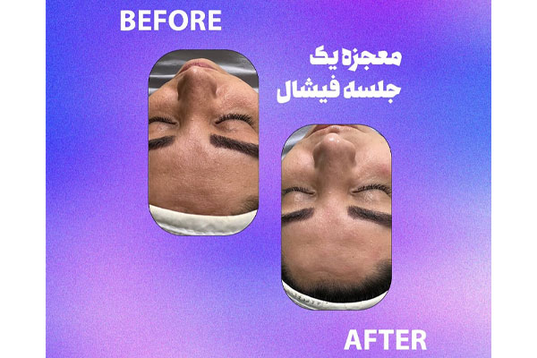 فواید شگفت انگیز فیشیال برای پوست