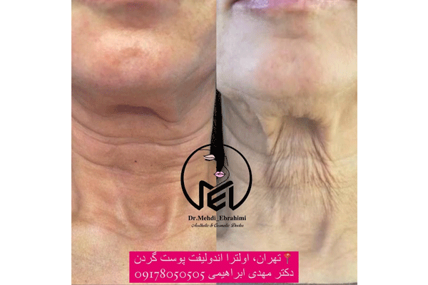 مزایای انجام اولترا اندولیفت