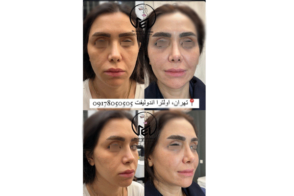 اولترا اندولیفت چگونه است