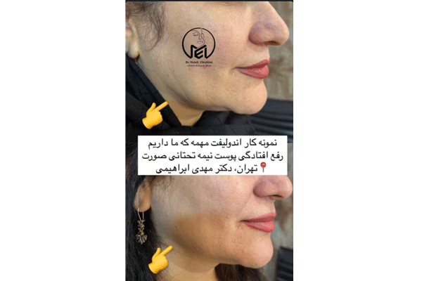 مراحل انجام اولترا اندولیفت