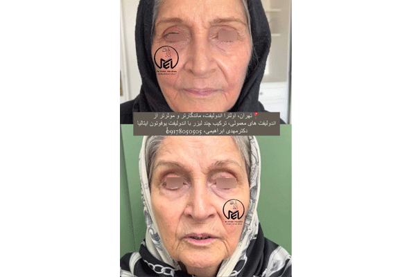 اولترا اندولیفت چیست