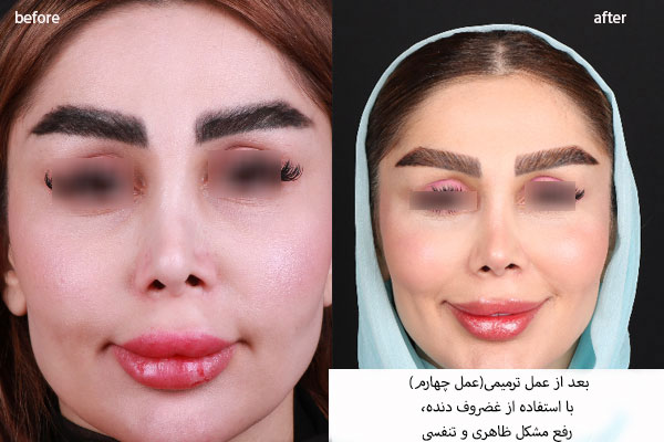 مراحل انجام عمل فانتزی و نیمه فانتزی بینی