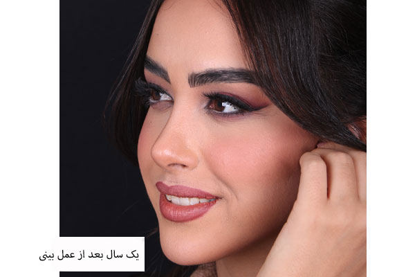 نقش جراح در انتخاب مدل مناسب بینی