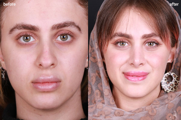 جراحی بینی فانتزی؛ انتخابی خاص با شرایط خاص