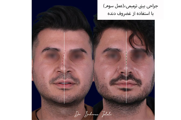 جراحی بینی طبیعی؛ انتخابی ماندگار و هماهنگ با چهره