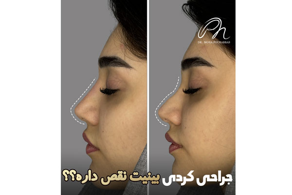 فرم دهی بینی مناسب چه اشخاصی است؟ 